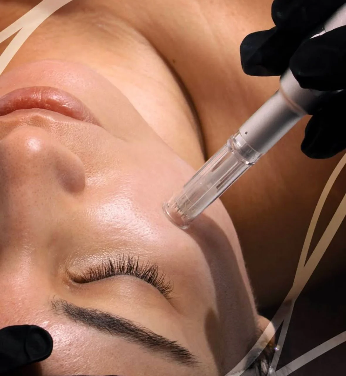 Skin Needling (Collagen Induction Therapy)